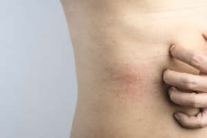 La dermatitis es una enfermedad bacteriana de la piel - HeelEspaña