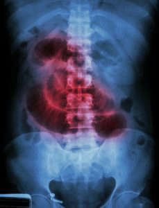 Obstrucción intestinal: síntomas, diagnóstico y tratamiento: obstruccion intestinal causas heelprobiotics heelespana 229x300 - HeelEspaña
