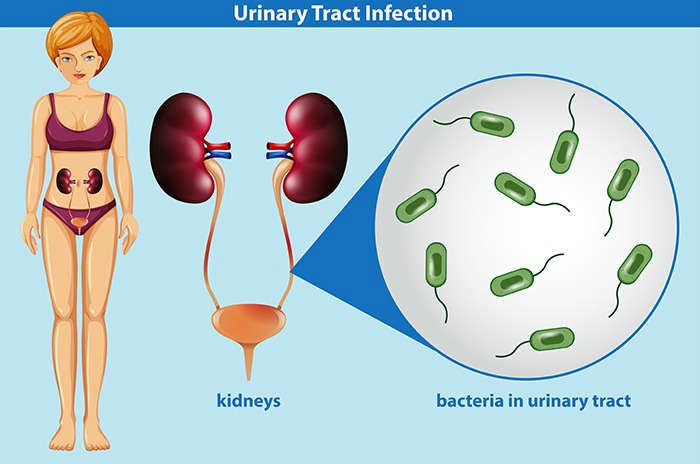 Infección urinaria recurrente: factores