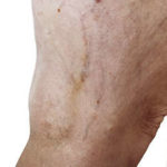 Pies y piernas hinchadas | Causas y recomendaciones: insuficiencia venosa 1 150x150 - HeelEspaña