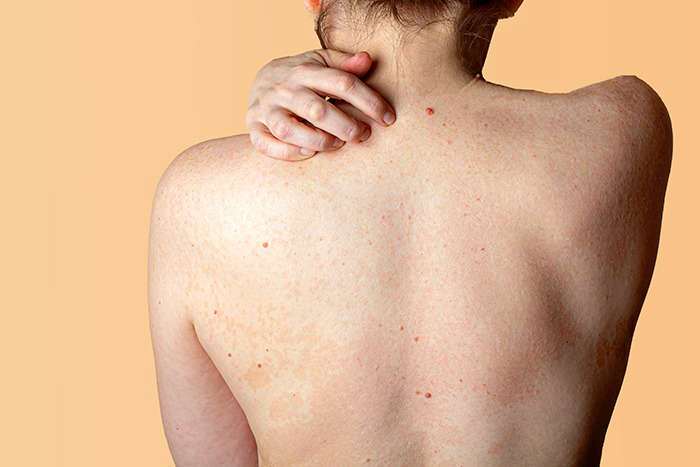 ¿Puede producir el coronavirus afecciones en la piel?: tratamiento coronavirus piel heelprobiotics heelespana - HeelEspaña