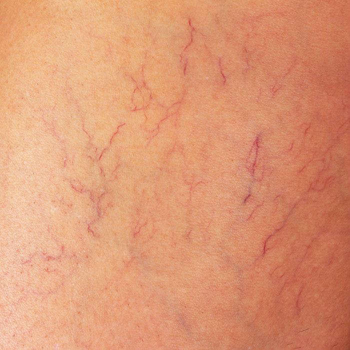 Tratamiento para las varices en las piernas: circulacion tratamiento varices - HeelEspaña