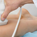 Pies y piernas hinchadas | Causas y recomendaciones: tratamiento varices 150x150 - HeelEspaña