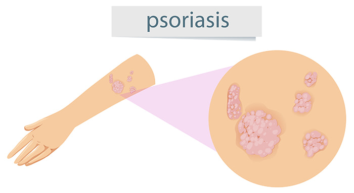 Psoriasis en las manos | Síntomas y tratamiento: psoriasis manos - HeelEspaña