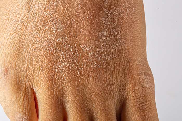 Xerosis de la piel por exposición a agentes externos: cuidados xerosis - HeelEspaña