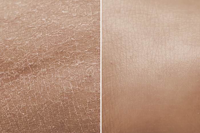 Xerosis de la piel por exposición a agentes externos: cuidar xerosis - HeelEspaña