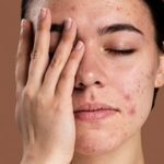 Manchas marrones en la piel: tratamiento y prevención: causas piel grasa 150x150 - HeelEspaña