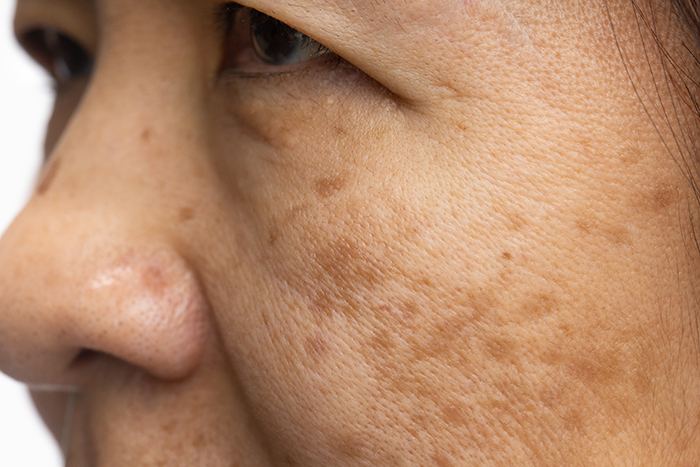 Manchas marrones en la piel: tratamiento y prevención: factores manchas marrones piel - HeelEspaña