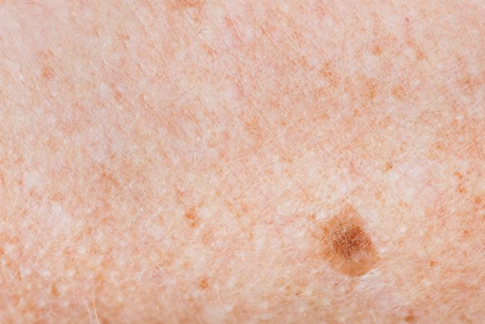 Manchas marrones en la piel: tratamiento y prevención: manchas marrones piel envejecimiento - HeelEspaña