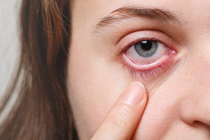 Irritación ocular por lentes de contacto: síntomas y soluciones efectivas: irritacion ocular lentes contacto - HeelEspaña