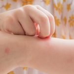Actualización en el tratamiento de la dermatitis atópica, ¿hay algo nuevo?